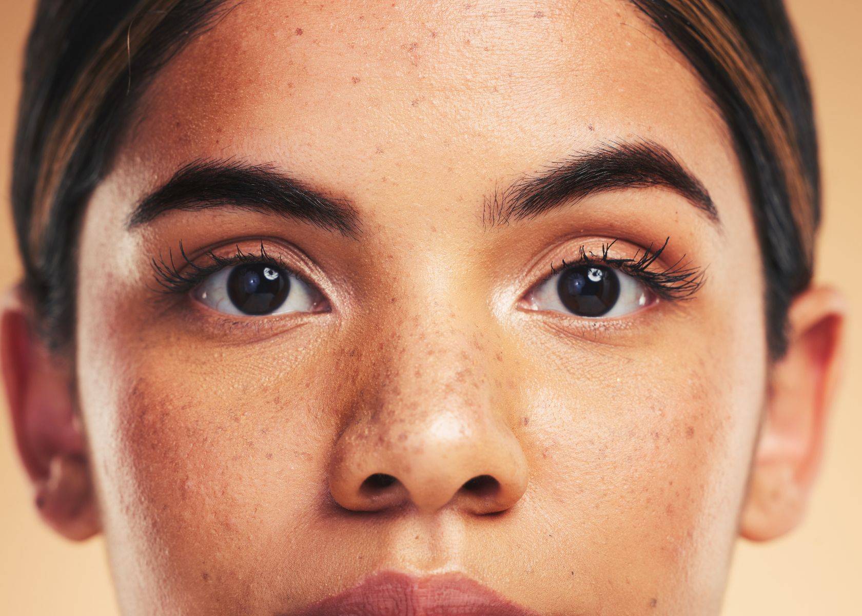 Causes of Melasma and Hyperpigmentation