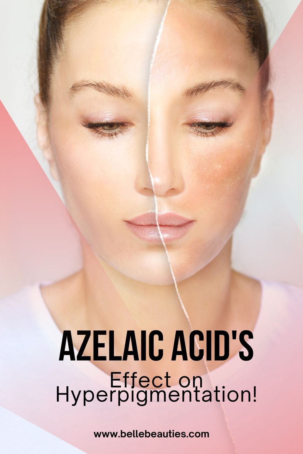 How Long Does Azelaic Acid Take to Work On Hyperpigmentation? pin