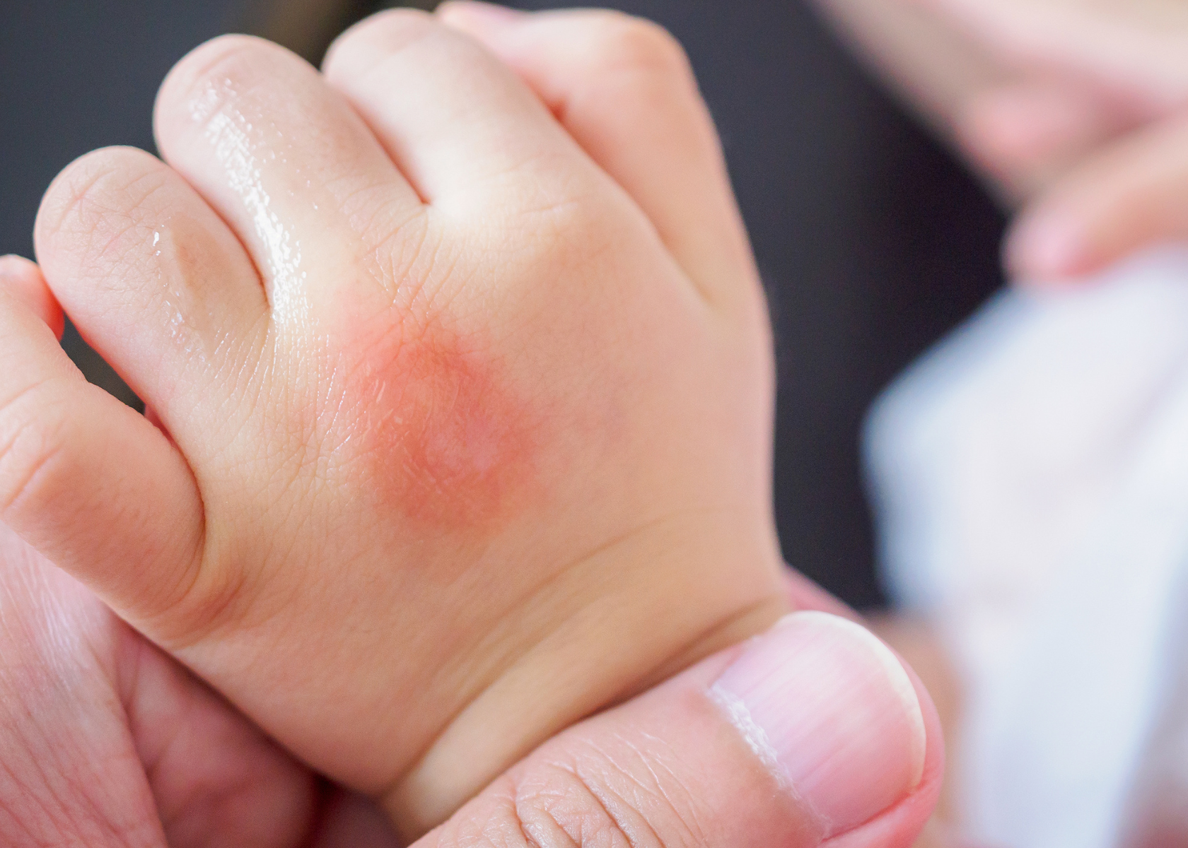 Tips for Applying Mosquito Repellent Lotion on Babies