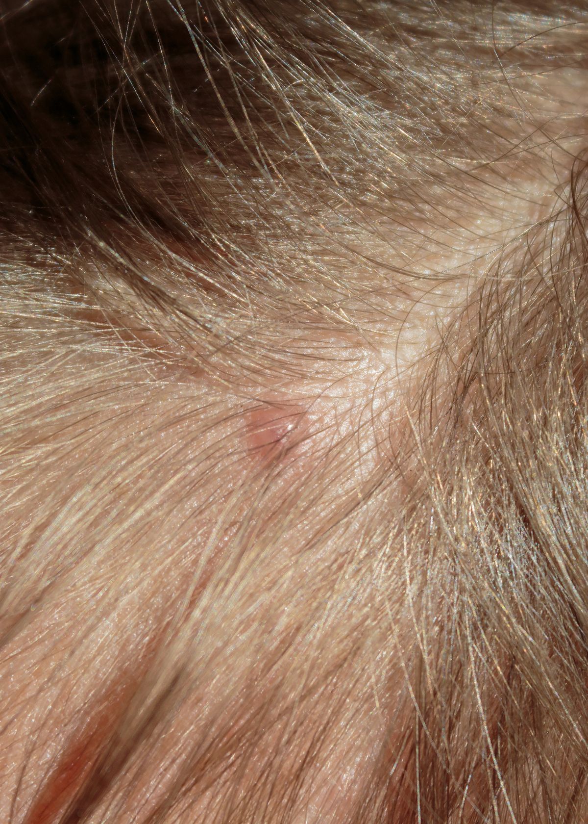Why Am I Getting Pimples On My Scalp?