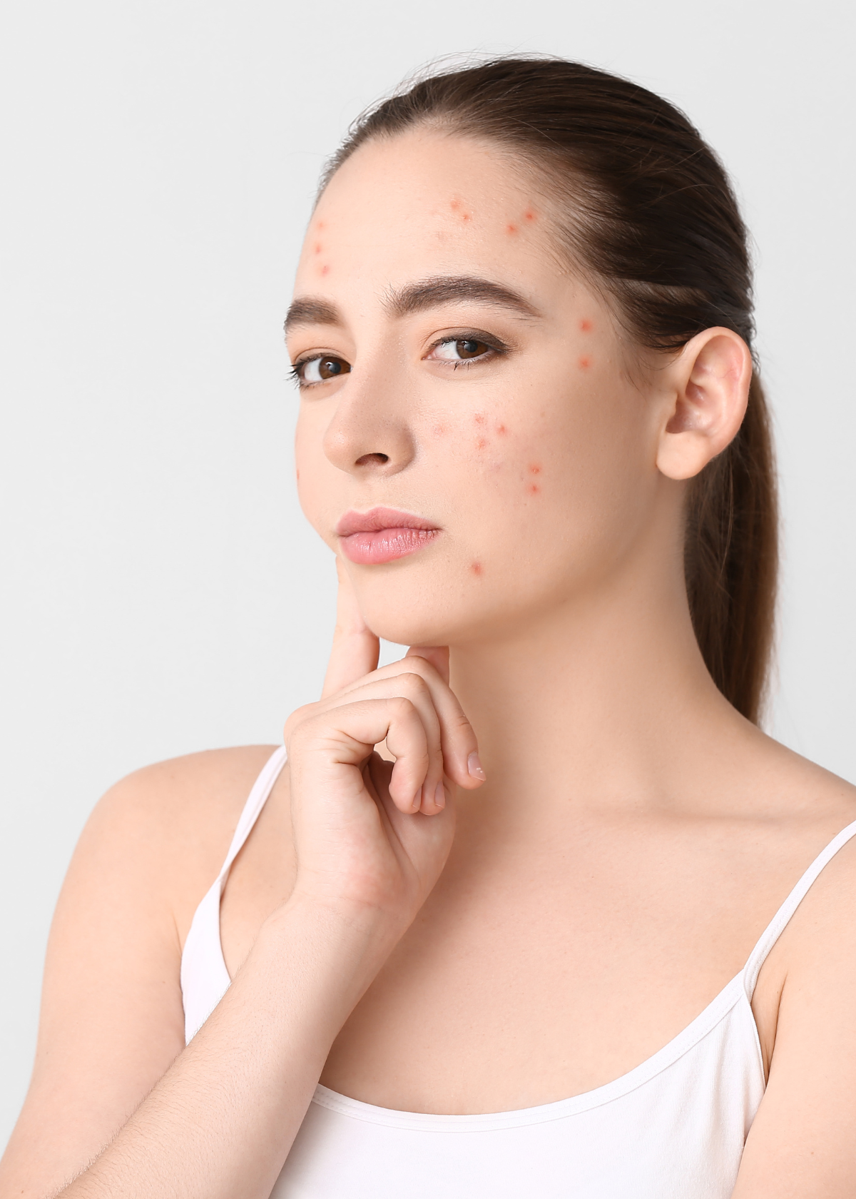15 Best Moisturizers for Fungal Acne and Soothing Your Skin