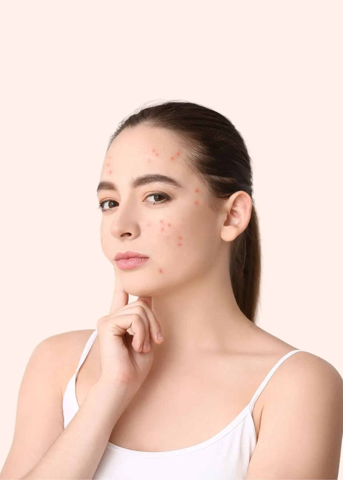 Foundation Tips For Acne: How to Achieve a Clear, Smooth Complexion